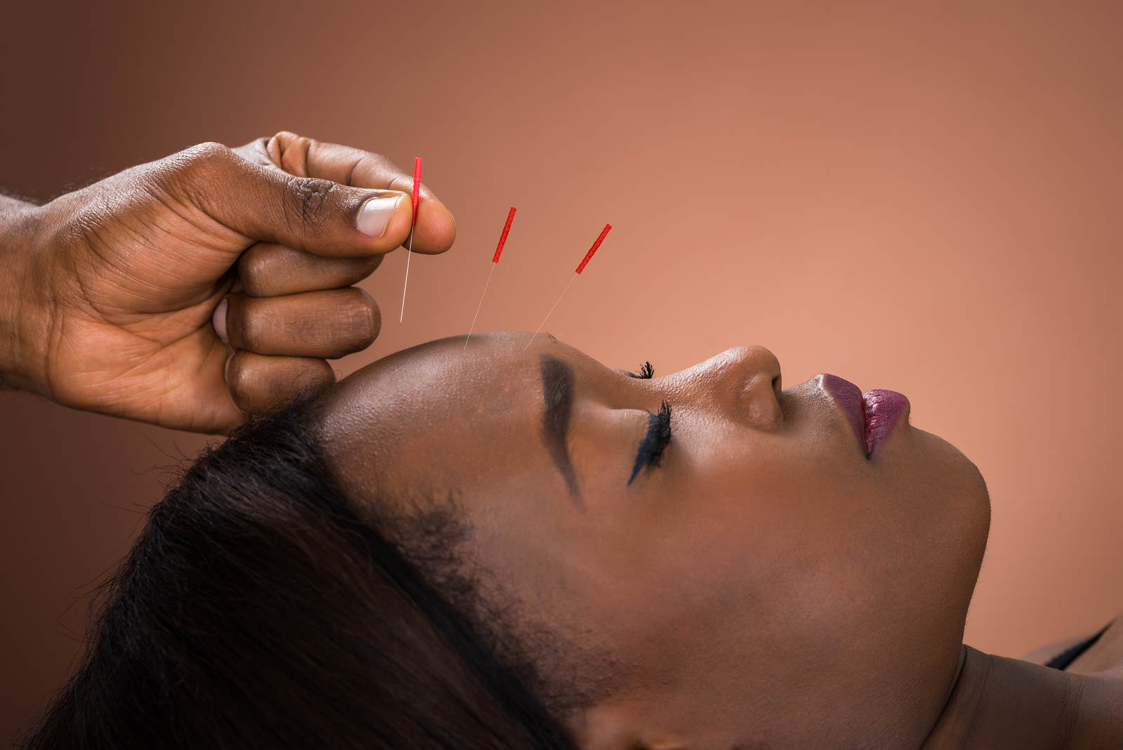 Acupuncture Treatment at Physician Partners of America